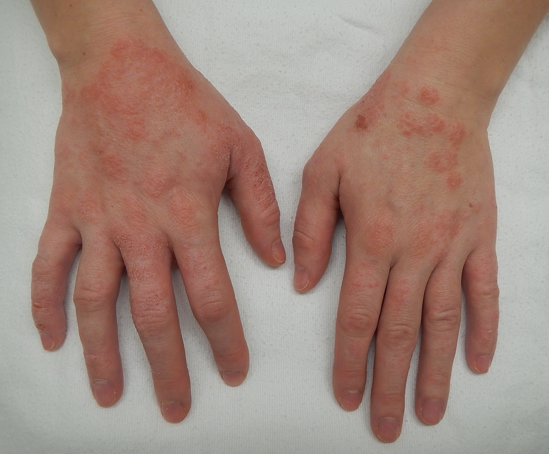 Eczema Triggers