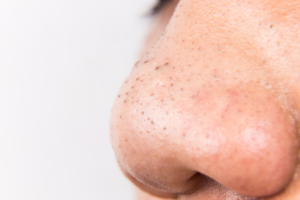 blackheads dermatologist North Carolina