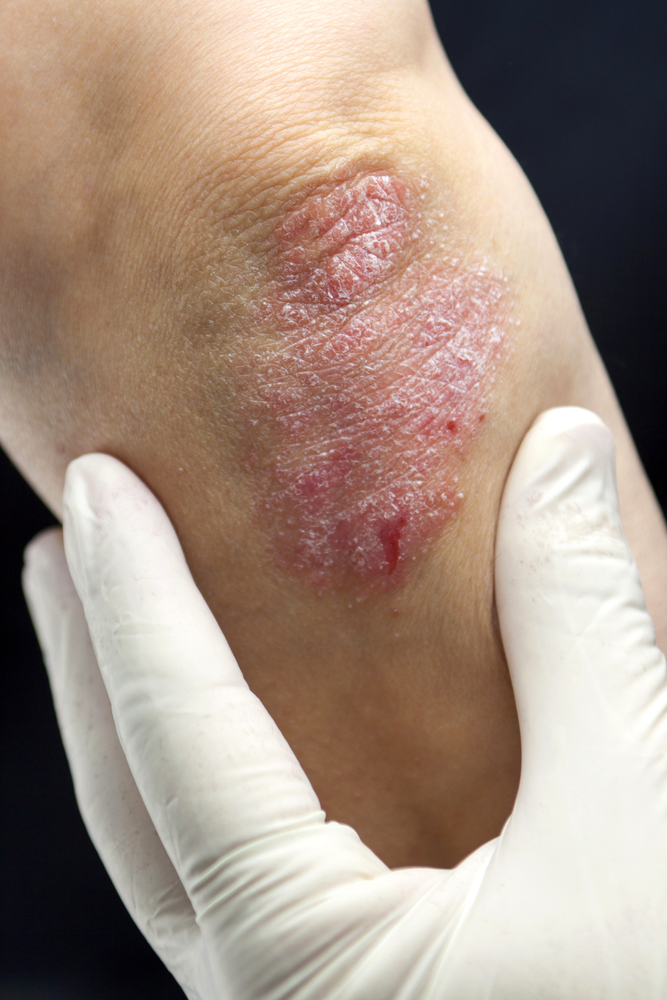 psoriasis dermatologist skin care nc