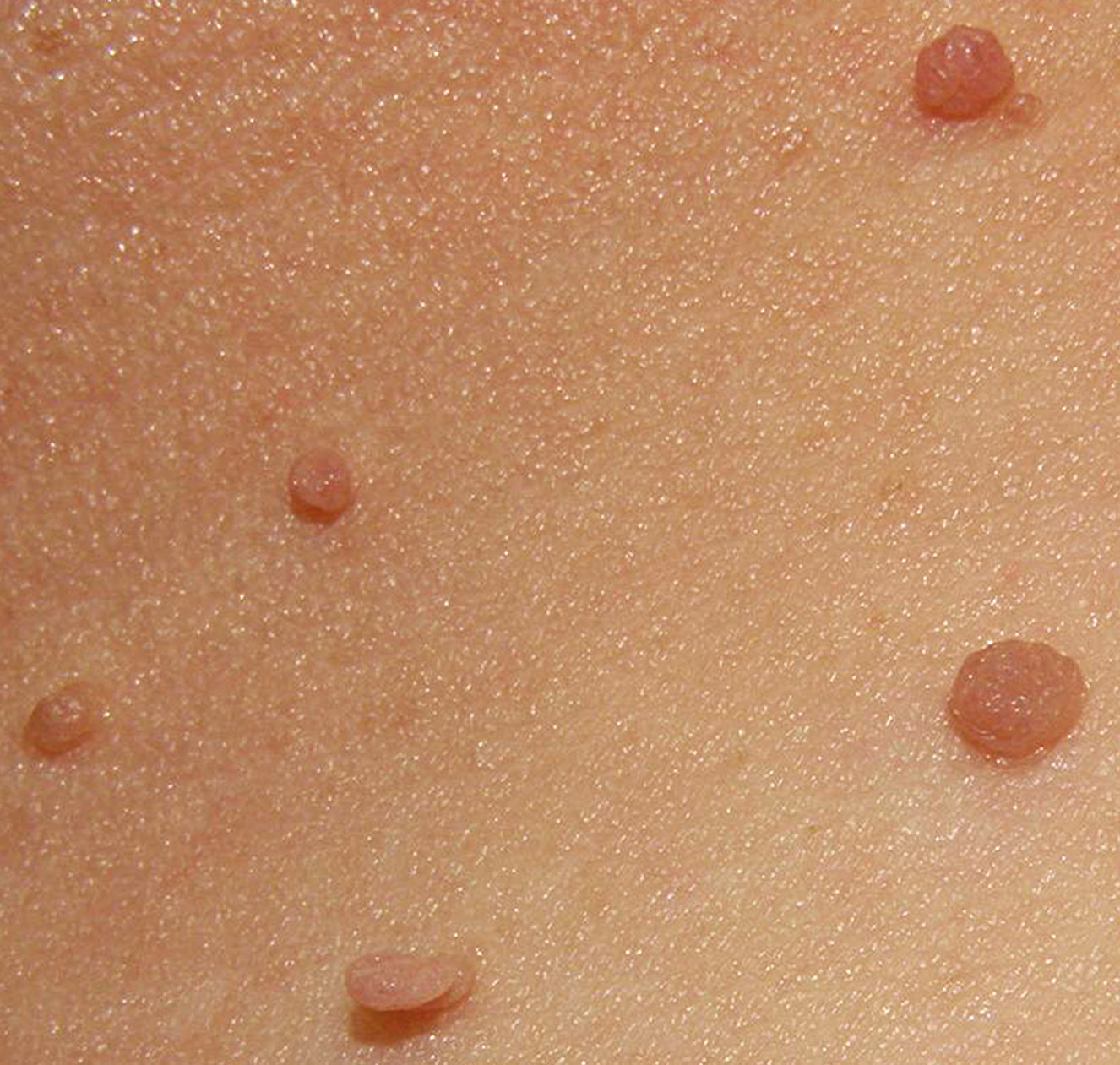 Skin tags