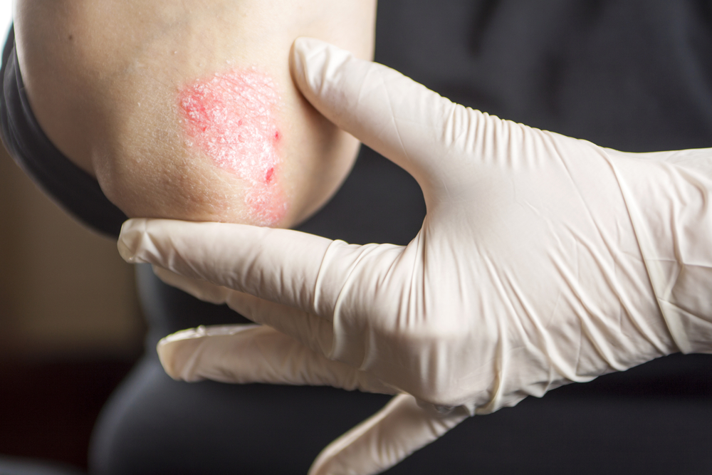 north caolina dermatology and skin surgery center eczema