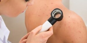 Dermatologist Shares 5 Tips to Clear Up Back Acne