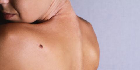 How to Check for Cancerous Moles - Asheboro