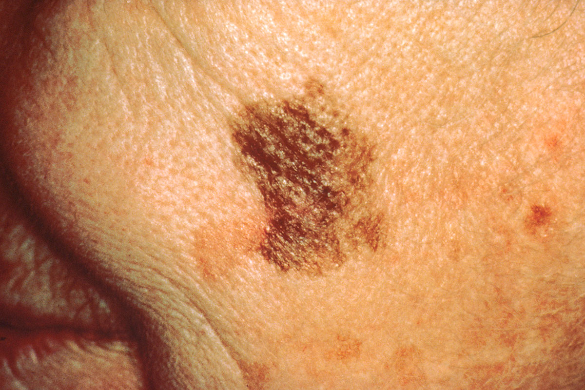 Melanoma Treatment Experts : Dermatology and Skin Surgery Center