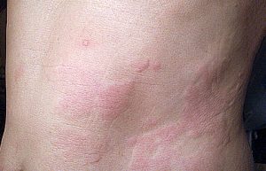 Chronic hives on the body