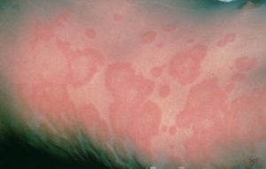An allergy to a medicine has caused hives on this person's body