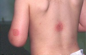 A child develops hives after getting bit by moquitoes