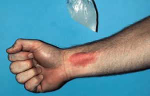 Welts on skin from cold are called urticaria hives